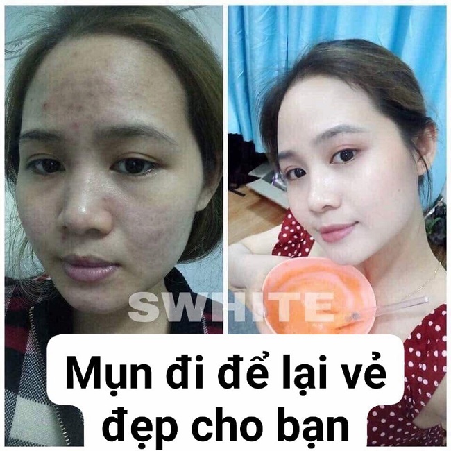 MẶT NẠ BẮC SWHITE