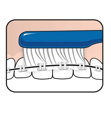 Bàn chải đánh răng TEPE (Implant / Chỉnh nha) - Lông bàn chải siêu mềm