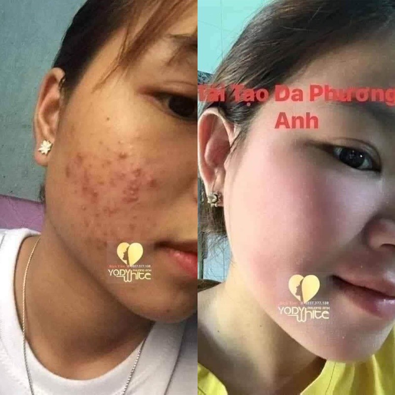 [HCM][XÃ KHO SALE OFF] Chấm Xóa Nám Rỗ Tàn Nhang YODY WHITE (Chính hãng - Số lượng có hạn)