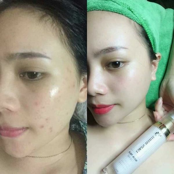 Combo Ủ Trắng Kén Tằm + Noãn Thực Vật
