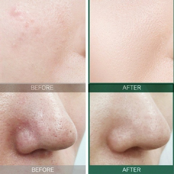 Combo 2 sản phẩm giảm mụn Some By Mi AHA-BHA-PHA 30 Days Miracle (Serum 50ml + Kem 50ml)