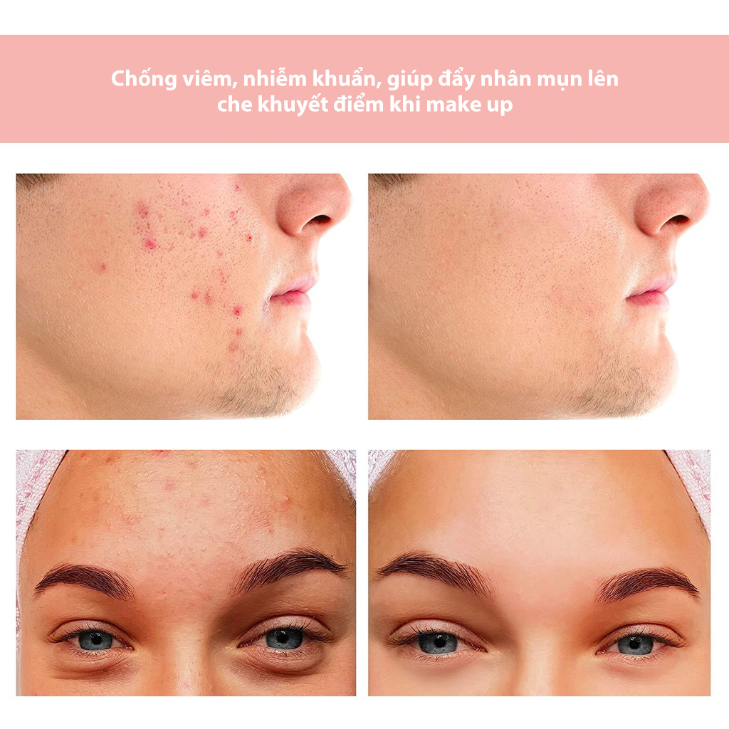 Set 36 miếng dán mụn ACNE PLASTERS, miếng dán làm xẹp che phủ mụn, miếng dán che mụn