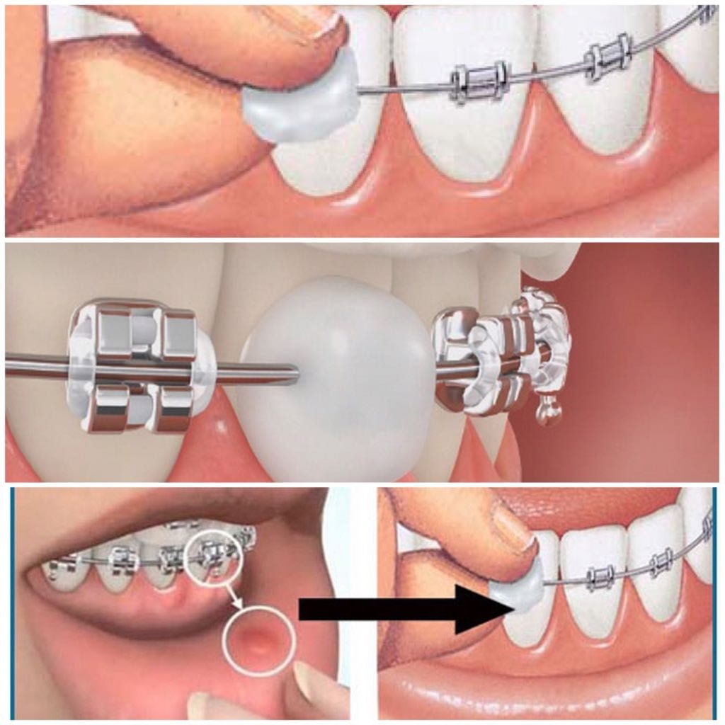 Dental wax