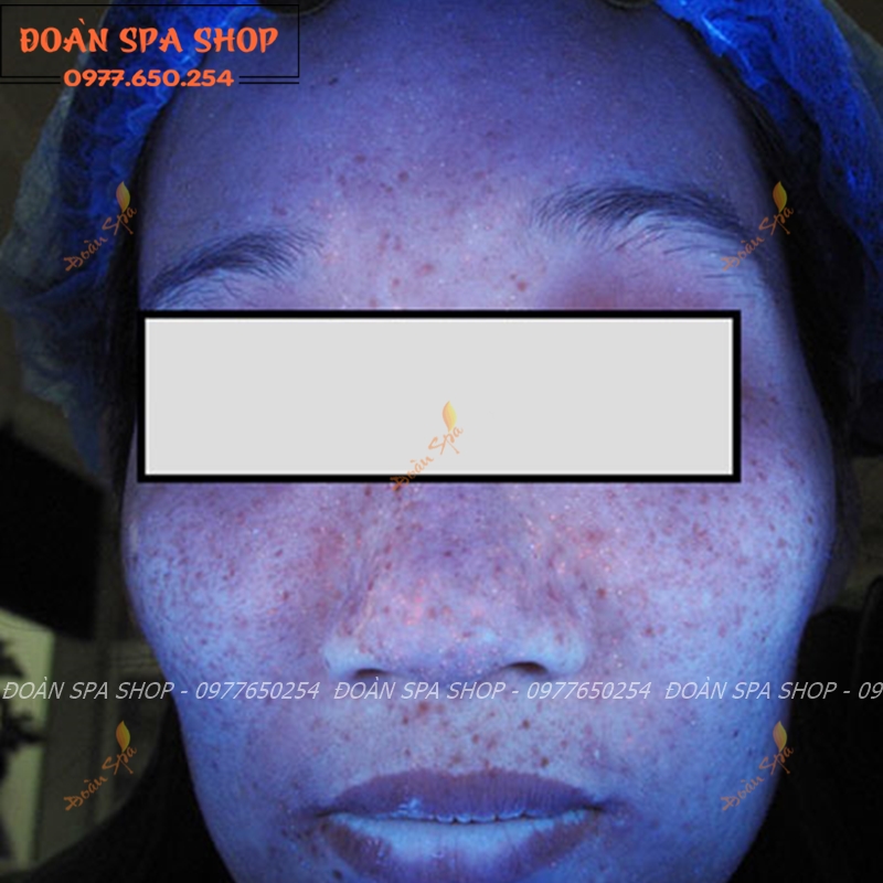 Đèn wood soi da dùng trong spa thẫm mỹ viện