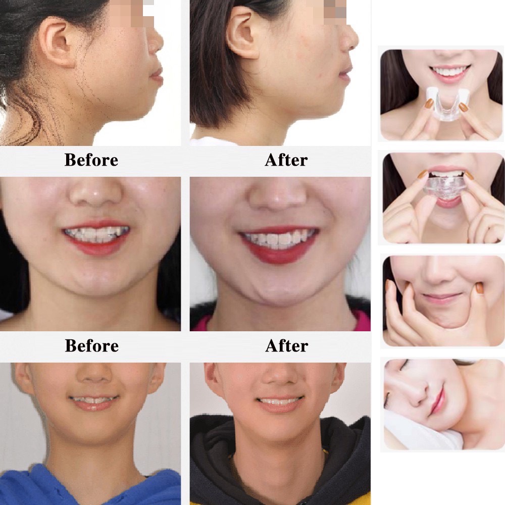 [HCM]Dụng cụ niềng răng trong suốt tại nhà Trainer COMBO [A1+A2+A3]