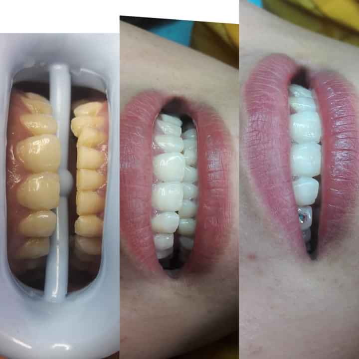 thuốc tẩy trắng răng philipin (bật tông cực trắng. không gây ê buốt)