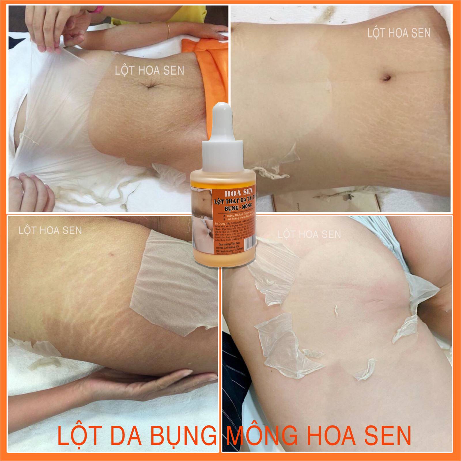 Lột Trắng Da Bụng Mông Bẹn Mờ Rạn Da Thâm Sạm