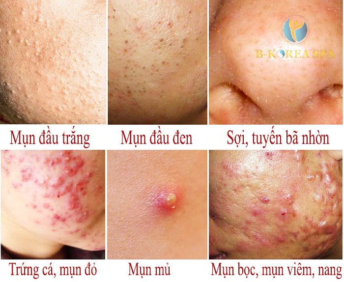 Serum trị mụn Acne Ampoule Larian Hàn Quốc