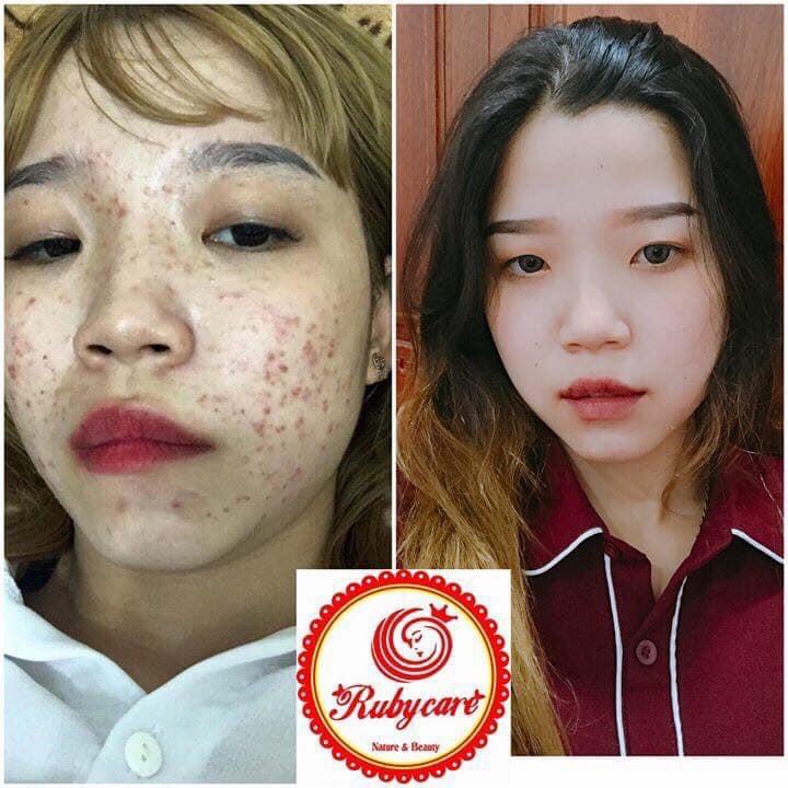 Đặc Trị Mụn RubyryCare