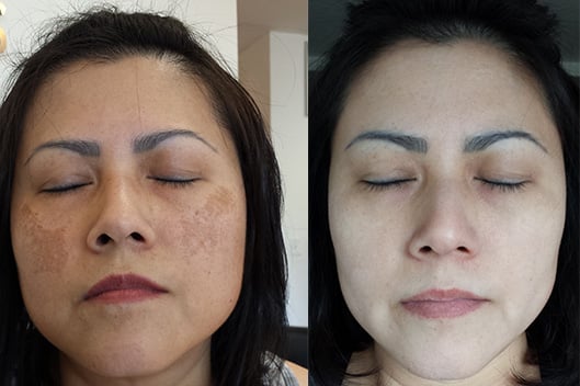 Serum nám Hoa Anh Đào 30ml