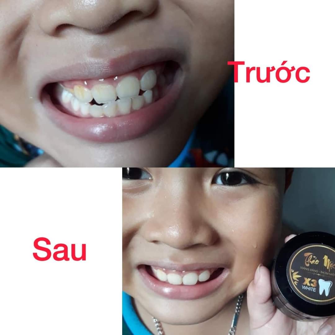5 hộp Bột trắng răng thảo mộc 37