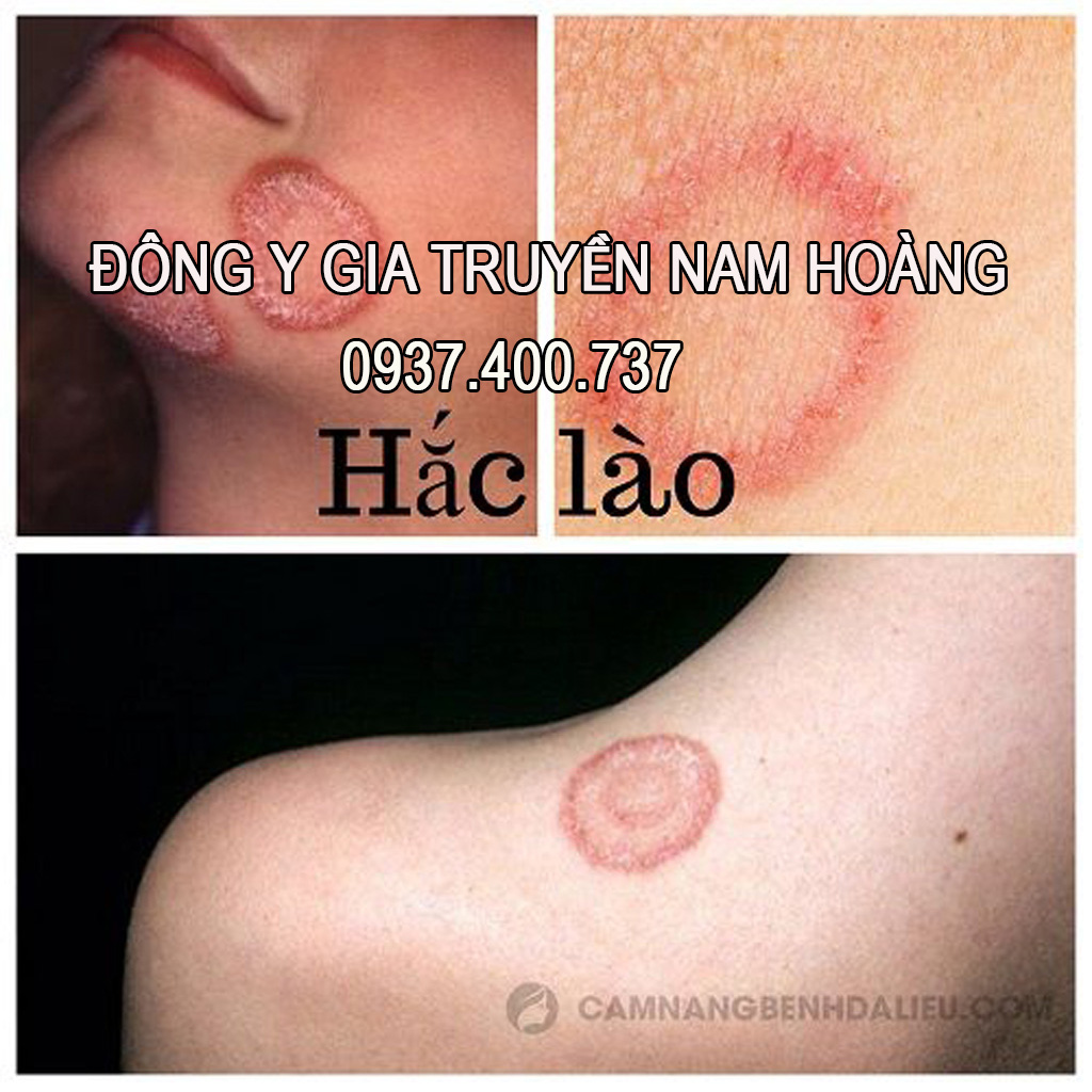 Thuoc Tri Benh Hac Lao Nam Hoang