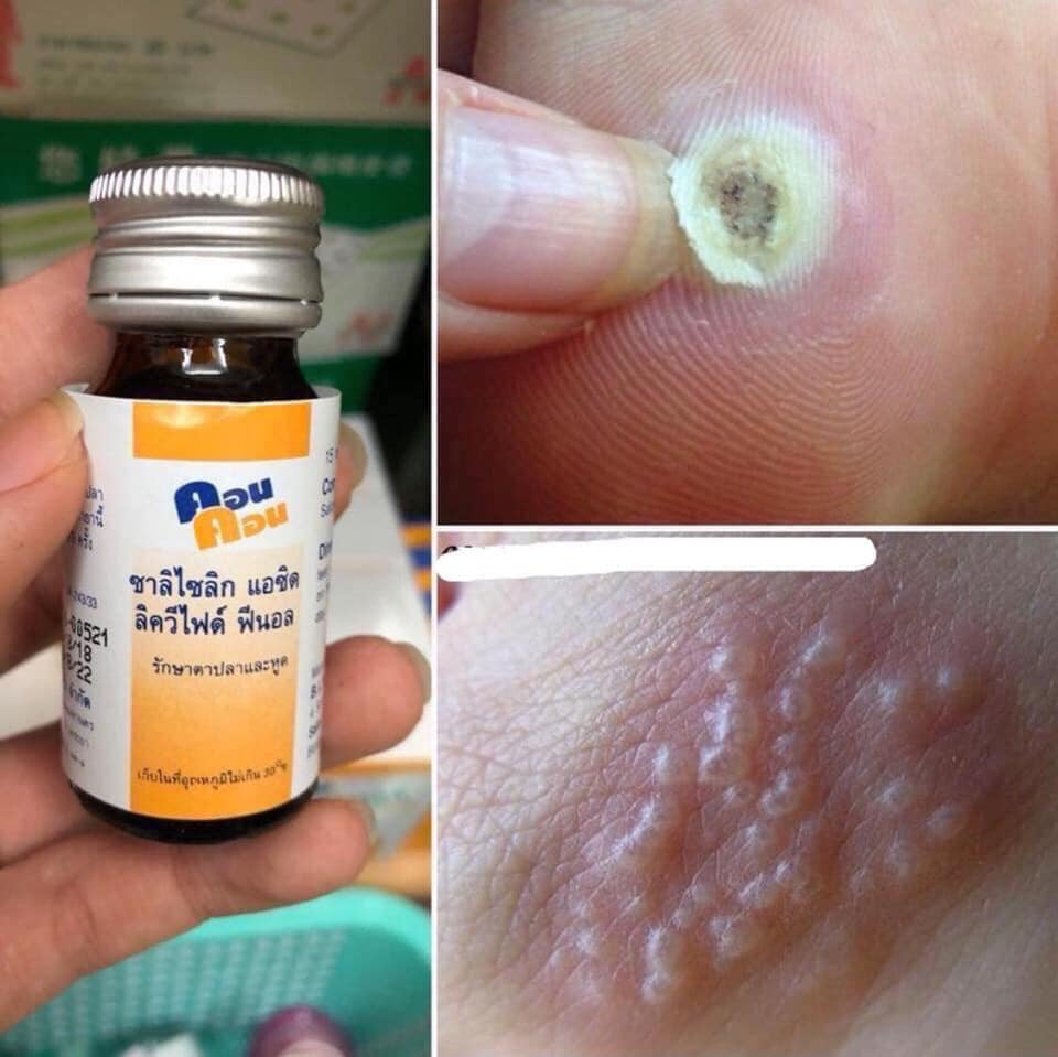 Bôi Mụn Cóc-Mụn Cơm-Nốt Ruồi CONCON Thái Lan
