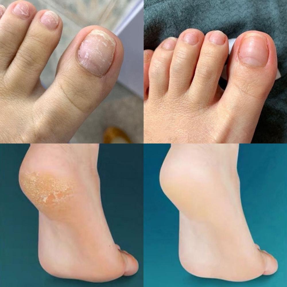 Bộ dụng cụ lấy khóe móng chân