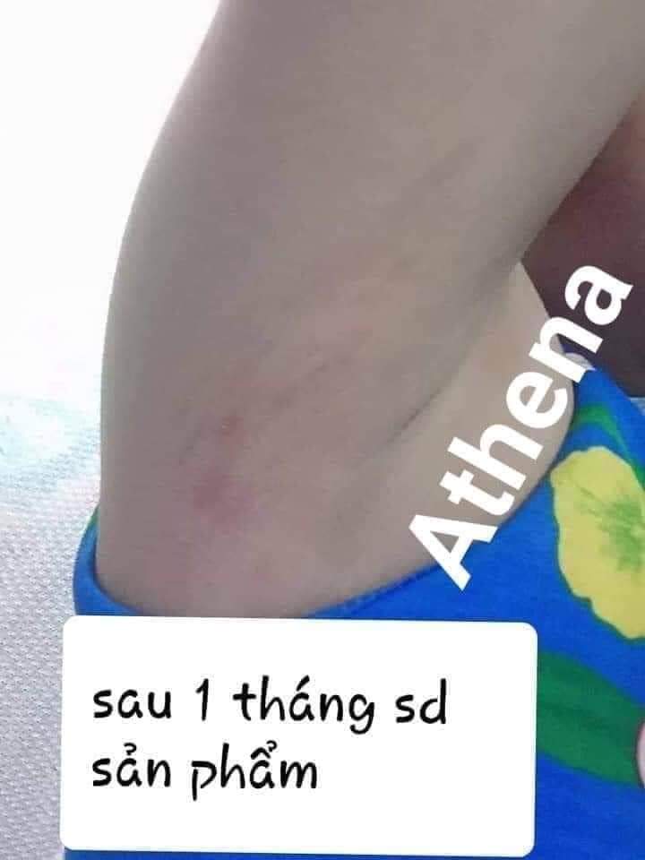 Kem xóa\làm mờ rạn da\thâm da Multi 16