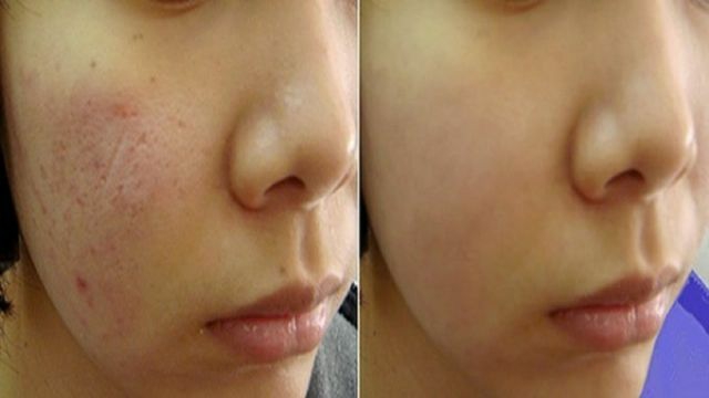 [HCM]Serum Lành sẹo rỗ Macoizy kích thích sản sinh Collagen