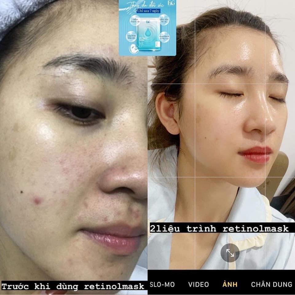 Mặt nạ RETINOL E&G trắng da trẻ hóa làn da