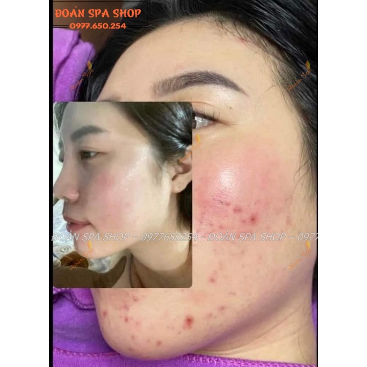 Vi sinh mụn hạt DevaCell - Vi sinh mụn Deva Cell