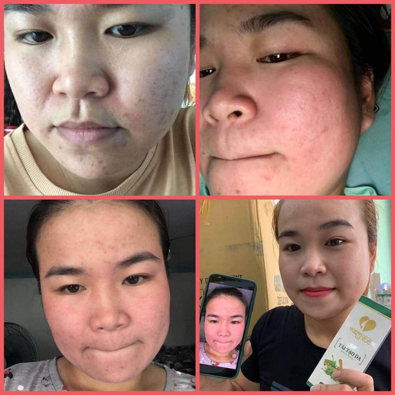 [TẶNG BALO TRÁI TIM]-THẢO DƯỢC TÁI TẠO DA PHƯƠNG ANH