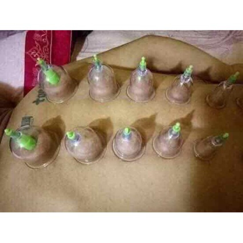 Bộ giác hơi 12 ống tại nhà