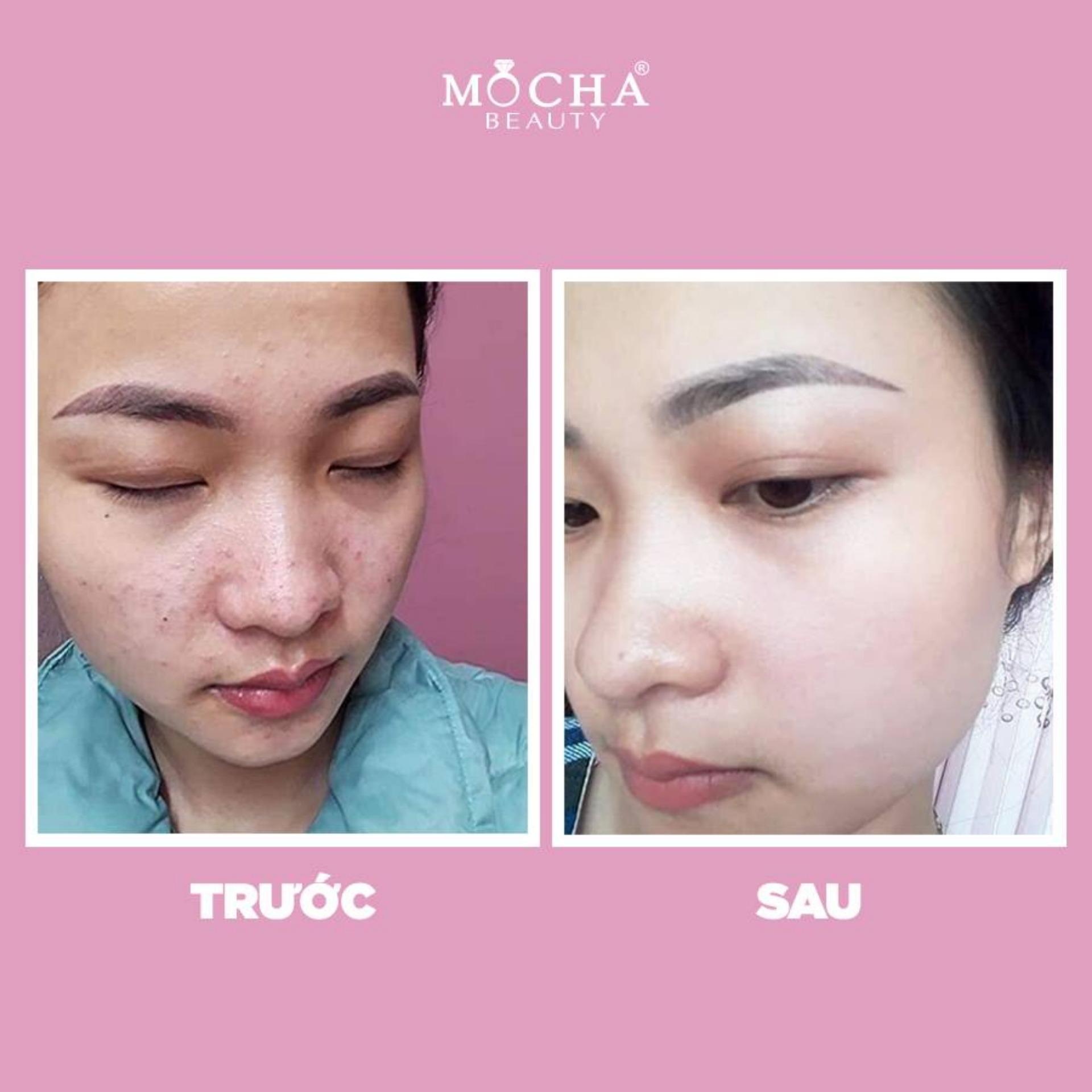 Kem Mụn - Bộ MỤN MOCHA 60gram gồm 2 hộp