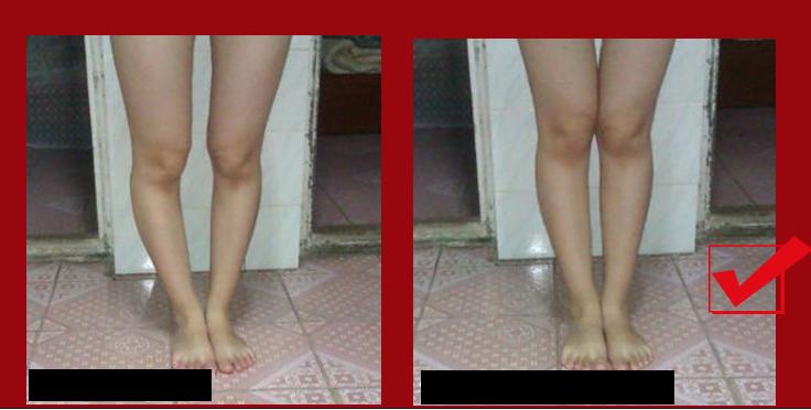 [HCM]ĐAI NẮN CHÂN VÒNG KIỀNG│Cực kỳ hiệu quả