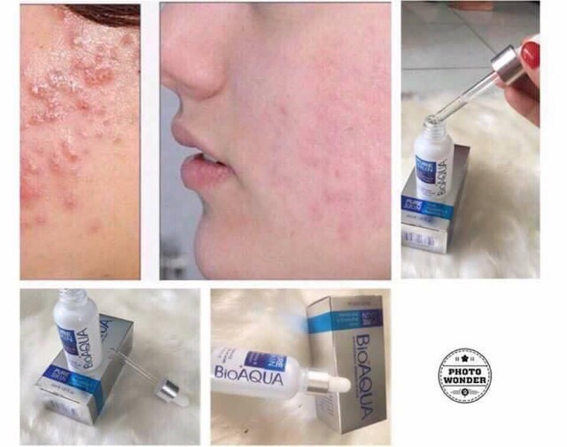 Serum trị mụn của bioaqua