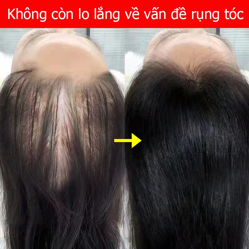 Tinh chất mọc tóc tinh dầu mọc tóc 30ml serum kích mọc tóc chăm sóc tóc chống rụng tóc,kích thích tóc mọc dà