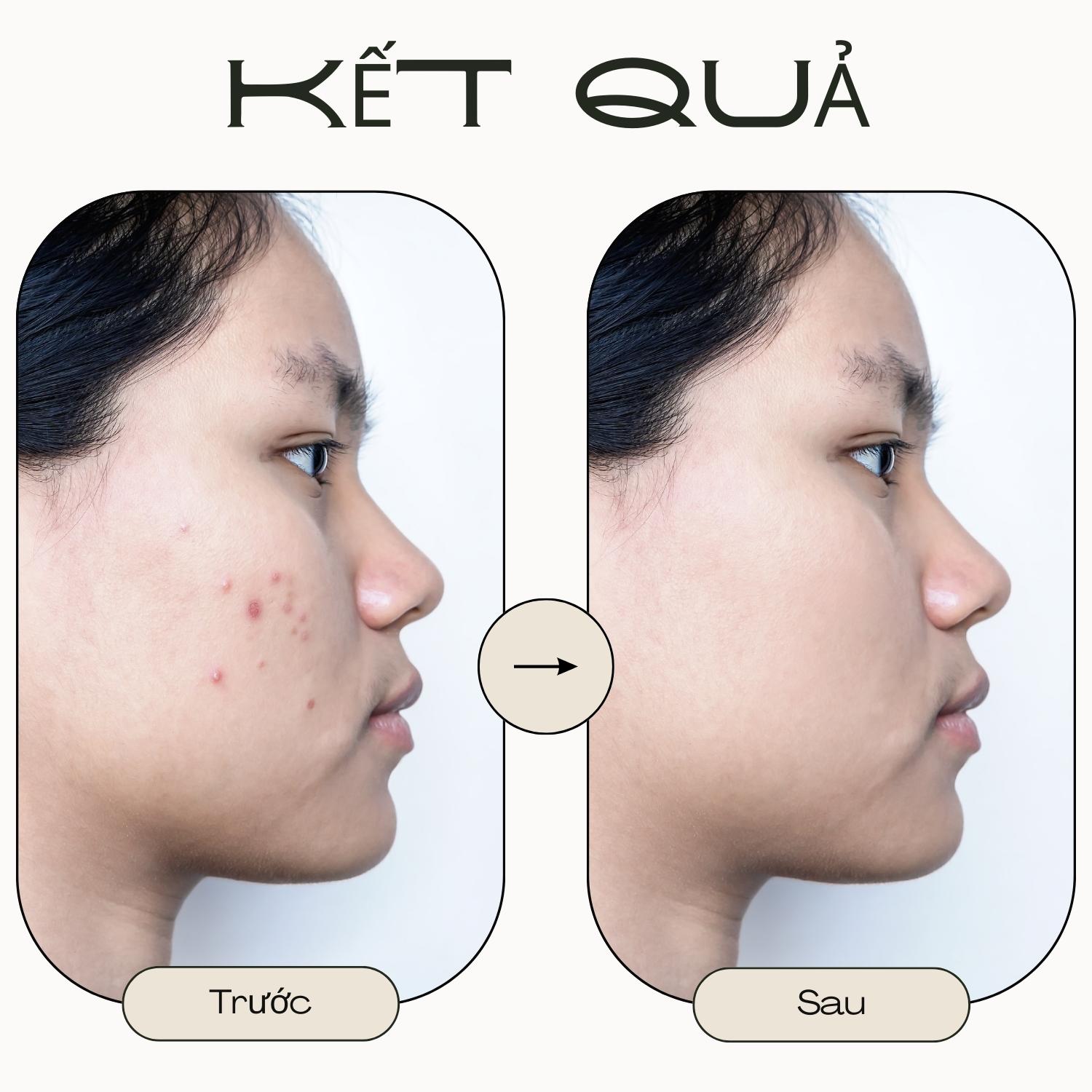 Kem Tri Mụn thâm Doctor Care Acnes Elimination 20ml