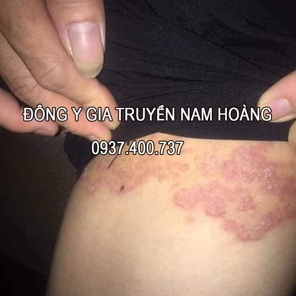 Thuoc Tri Benh Hac Lao Nam Hoang