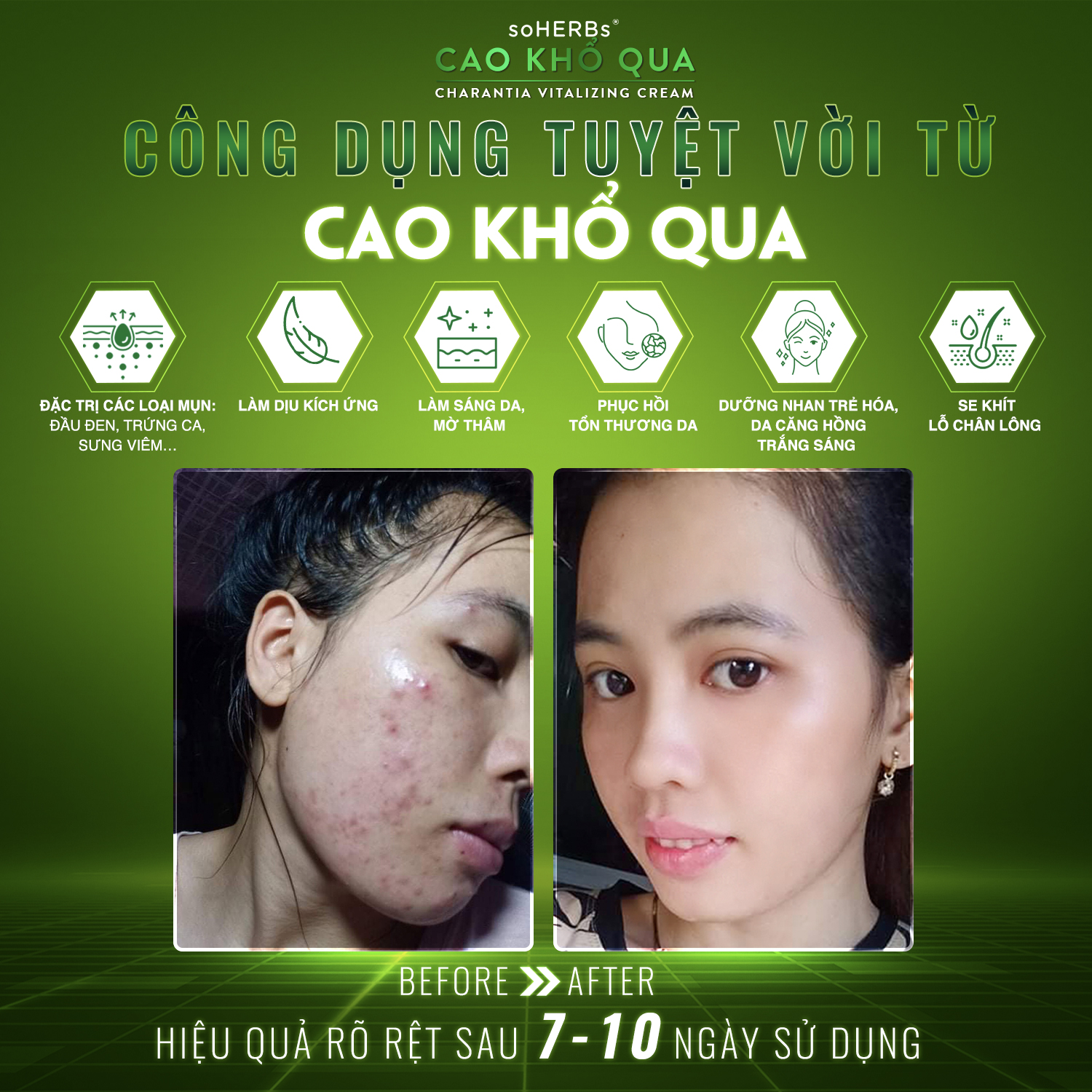 Cao Khổ Qua Giảm Mụn Soherbs Charantia Vitalizing Cream
