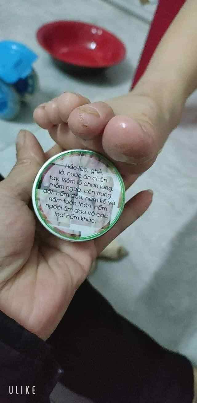 VIÊM DA TRẦN KIM HUYỀN