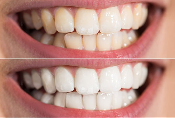 HSD 08/23 - LẺ 1 GÓI (2 MIẾNG) Dán trắng răng ORAL B
