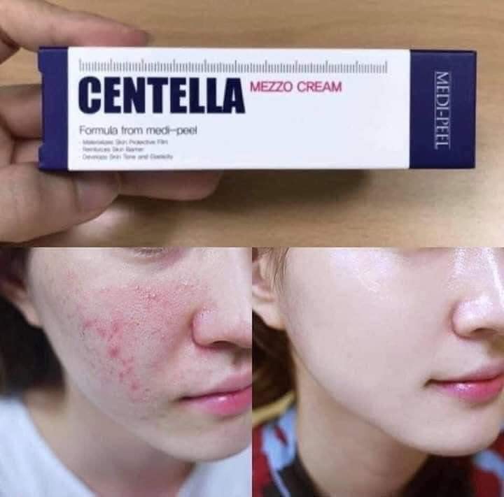 KEM TRỊ, MỤN CENTELLA MEDIPEEL
