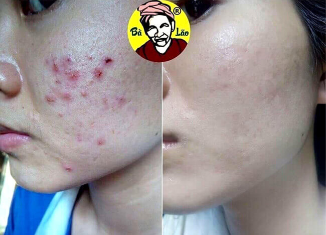 [HCM]CỰC CHẠY - BÀ LÃO CAO CẤP DÀNH CHO DA NHẠY CẢM