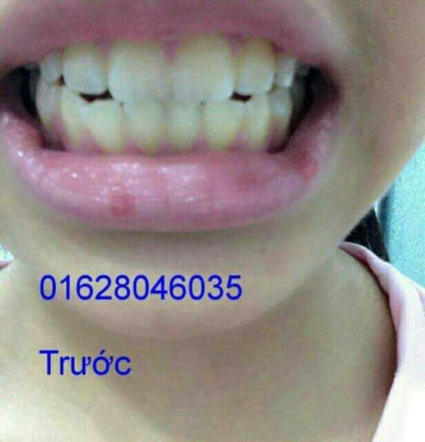Máng Tẩy Trắng Răng Tại Nhà Khít Răng 100%