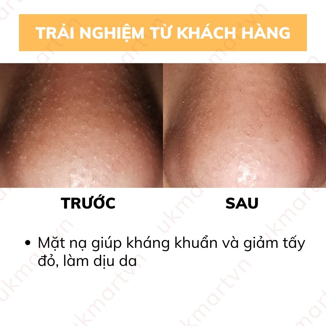 HCM ship 2h]Mặt Nạ Ngăn Ngừa Mụn Café Mimi Anti-Acne Face Mask ...