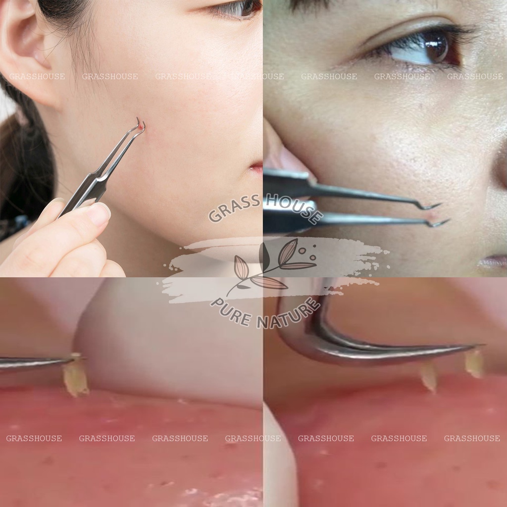 NHÍP LẤY MỤN T07 VACOSI ĐẦU SIÊU NHỎ