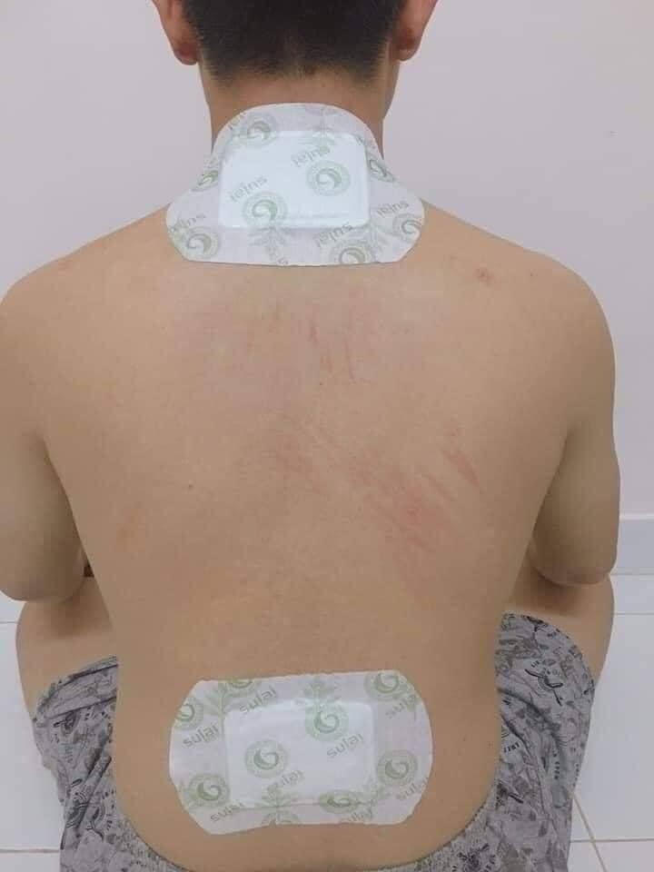 Miếng dán thải độc toàn thân Sulai Cervical Vertebra THÁI LAN