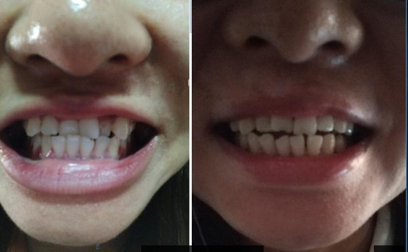 [HCM]DỤNG CỤ NIỀNG RĂNG | Dùng cho người lớn ( A1 + A2 +A3)