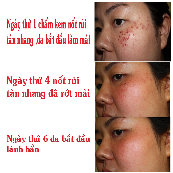 [HCM]Kem Xóa Nốt Ruồi Tàn Nhang Đồi Mồi