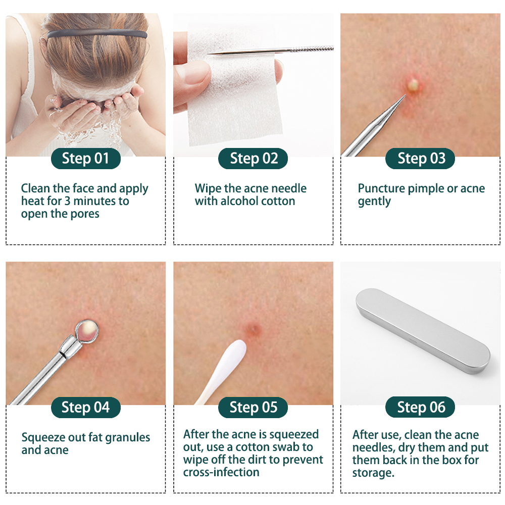 Bộ 5 dụng cụ nặn mụn Có Nhíp