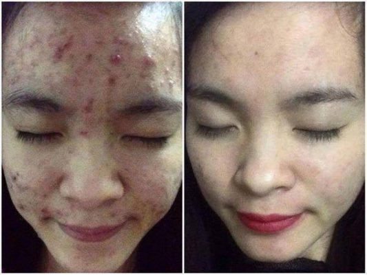 Chấm mụn siêu tốc Linh Sâm 12 lọ