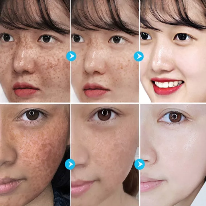 100ml Tinh chất dưỡng trắng serum Xóa nám nhanh chóng Tinh chất dưỡng ẩm dưỡng trắng sáng da loại bỏ nếp nhăn và nám thu nhỏ lỗ chân