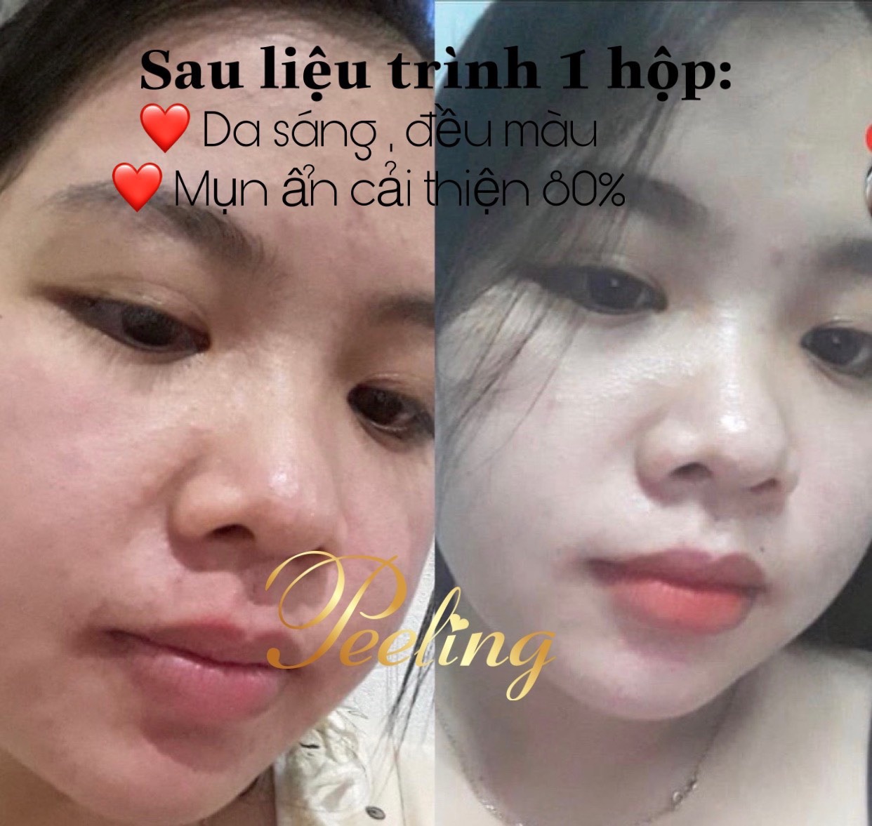 [HCM]kem Peeling Tái tạo da