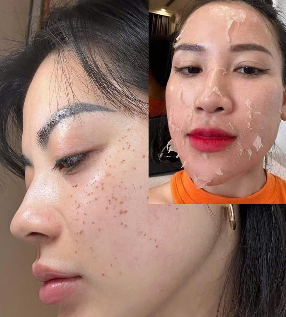 [Genuine] Yody Phuong Anh Skin Peeling Treatment Helps Even Skin Tone