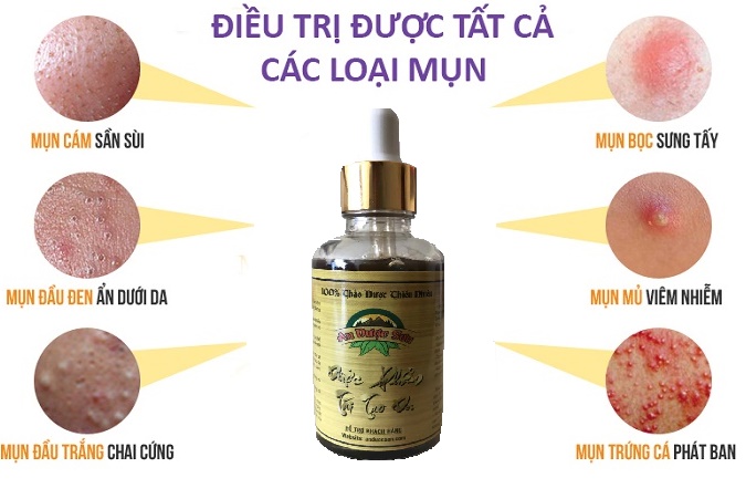 [HCM]Sạch Mụn Trắng Da An Dược Sơn 30ml