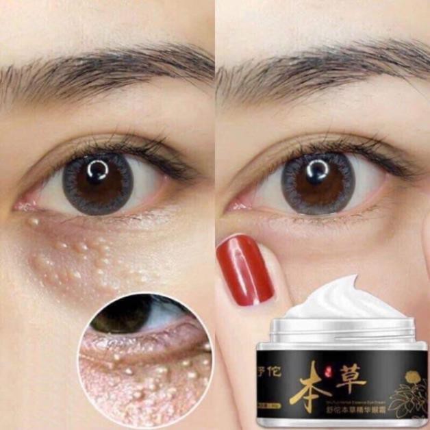 Kem Xóa Mụn Thịt Mắt Giảm Thâm Hết Bọng Mắt