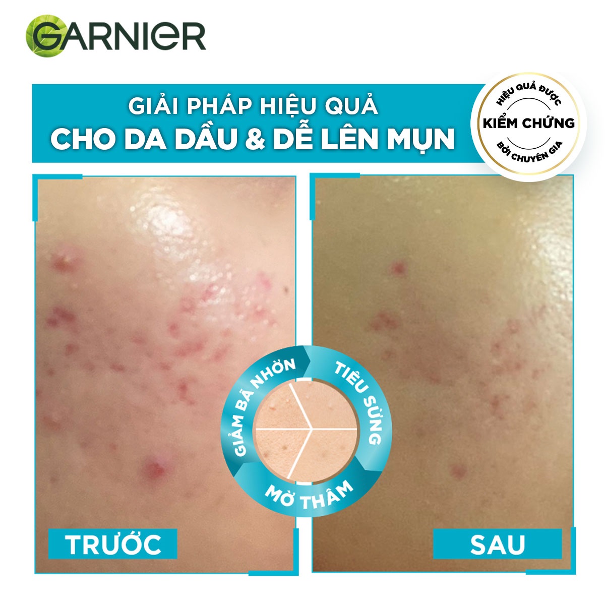 Tinh chất Garnier Bright Complete Anti Acne Booster 4% 7,5ml