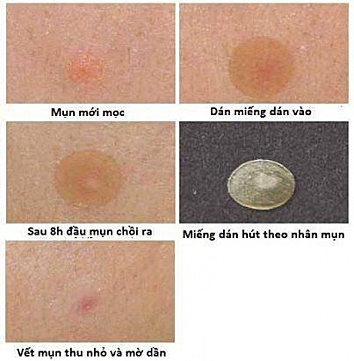 Miếng dán mụn Cosrx Acne Pimple Master 24 patch